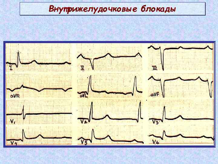 Нарушение внутрижелудочковой