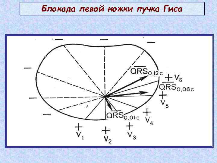 Блокада левой ножки пучка Гиса 