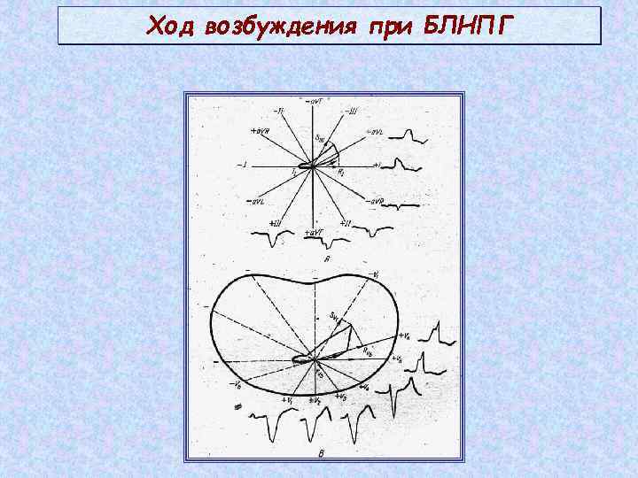 Ход возбуждения при БЛНПГ 