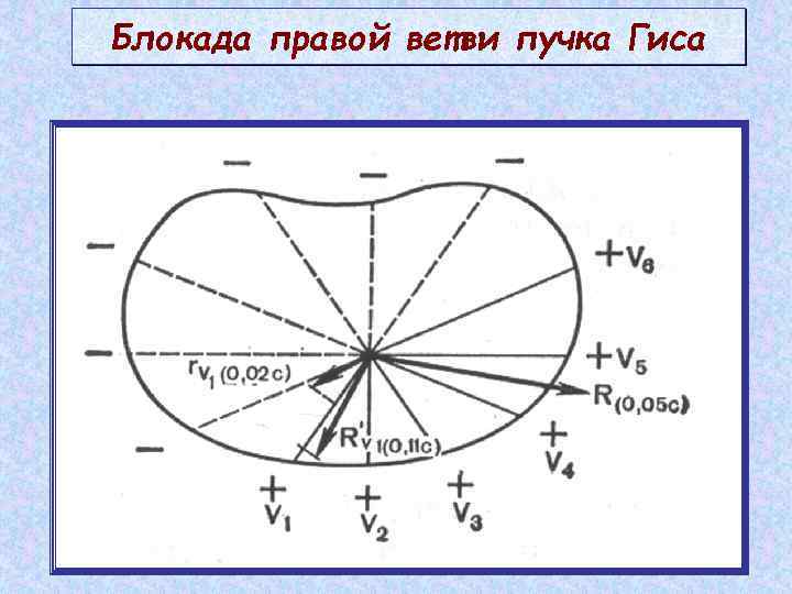 Блокада правой ветви пучка Гиса 