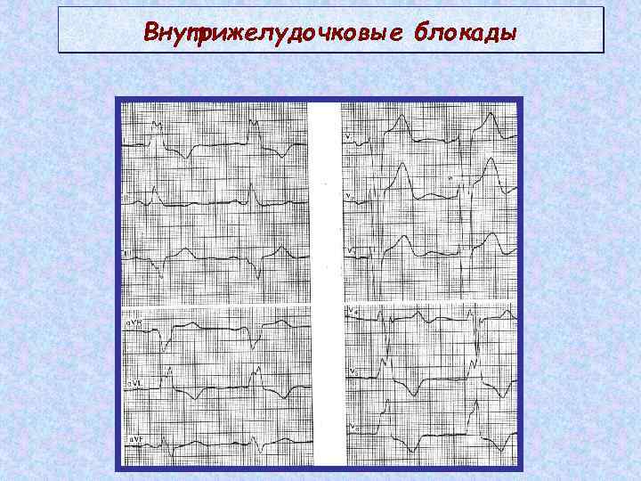 Экг нарушение проводимости. Внутрижелудочковые блокады на ЭКГ. Внутрижелудочковая блокада патфиз ЭКГ проявления. Основной ЭКГ признак внутрижелудочковой блокады. Внутрижелудочковые блокады на ЭКГ внутрижелудочковые.