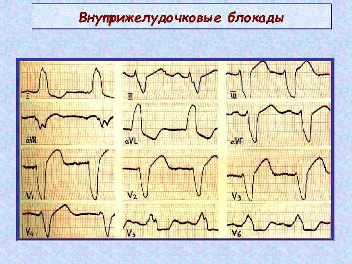 Внутрижелудочковые блокады 
