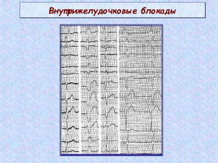 Внутрижелудочковые блокады 