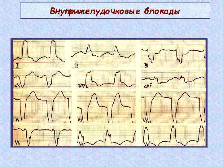 Внутрижелудочковые нарушения экг. • Внутрижелудочковые блокады (блокады ветвей пучка Гиса). ЭОС неспецифическая внутрижелудочковая блокада. Местная внутрижелудочковая блокада на ЭКГ последствия. Неспецифические внутрижелудочковые блокады v3 и v4.