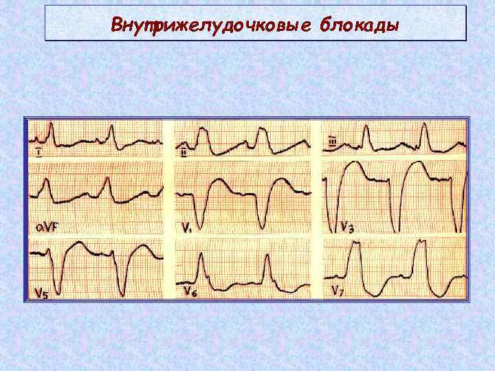 Внутрижелудочковые блокады 