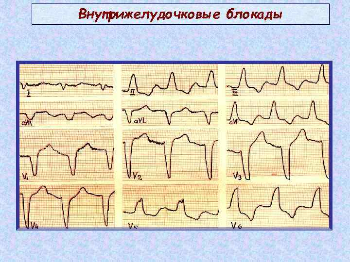 Местная внутрижелудочковая блокада — вопрос №2175218