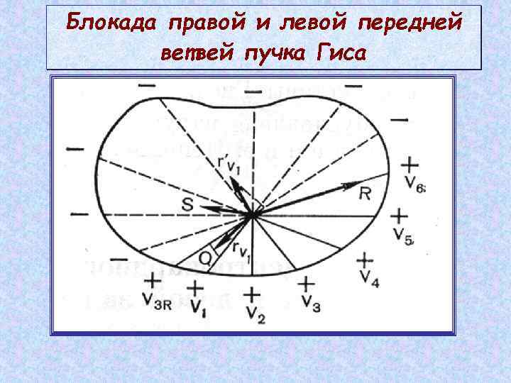 Блокада правой и левой передней ветвей пучка Гиса 