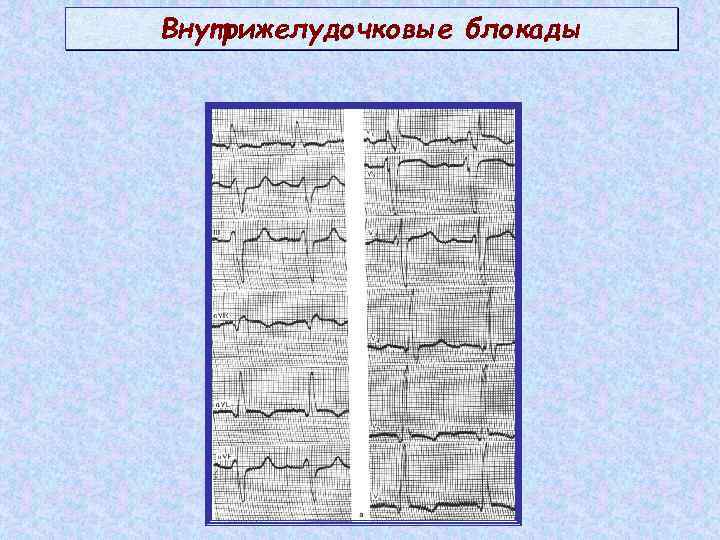 Внутрижелудочковые блокады 