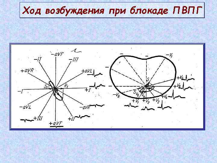 Ход возбуждения при блокаде ПВПГ 