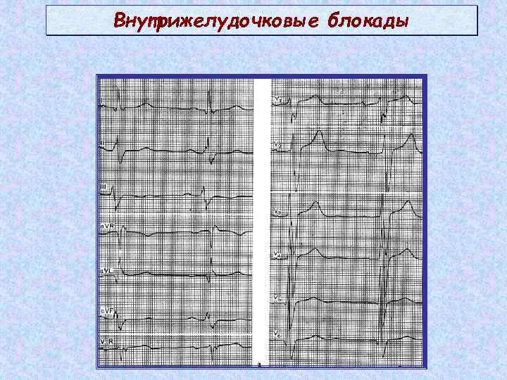 Внутрижелудочковые блокады 