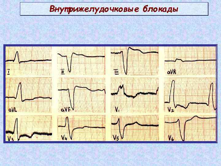 Внутрижелудочковая блокада: виды, причины, диагностика, … Foto 18