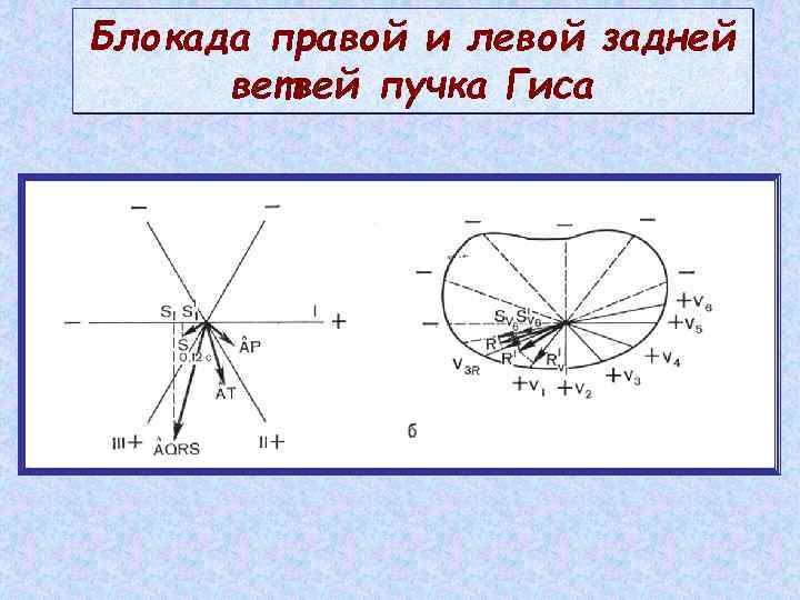 Блокада правой и левой задней ветвей пучка Гиса 