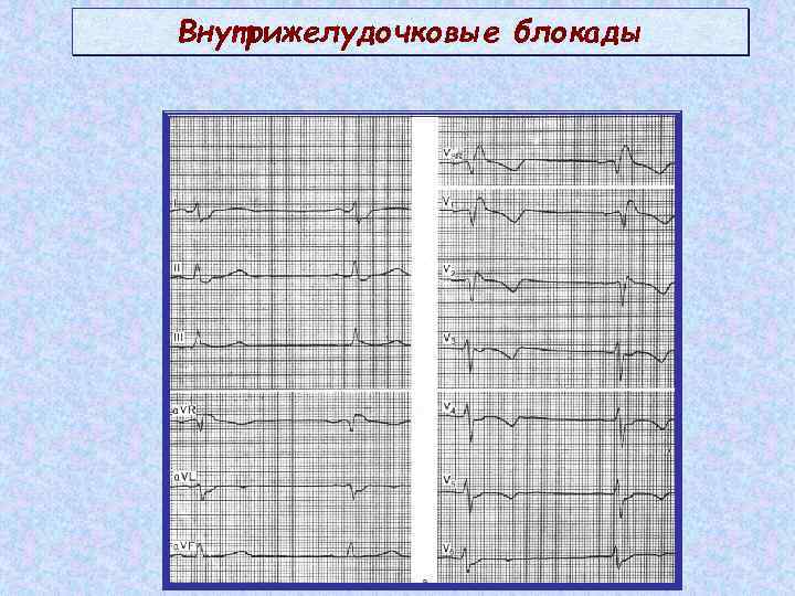 Внутрижелудочковые блокады 
