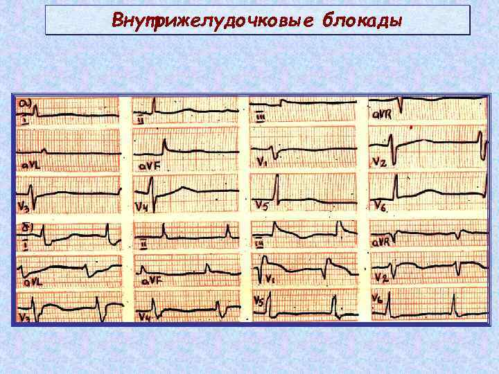 Внутрижелудочковые блокады 