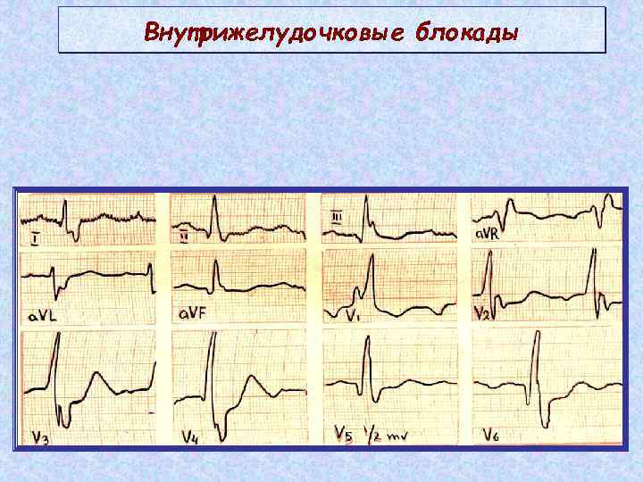 Местные нарушения внутрижелудочковой проводимости на экг