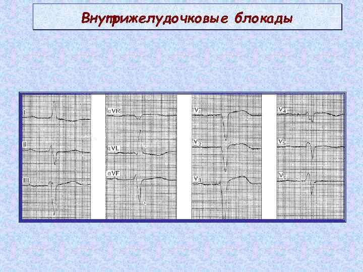 Внутрижелудочковые блокады 