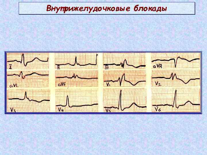 Внутрижелудочковые блокады 