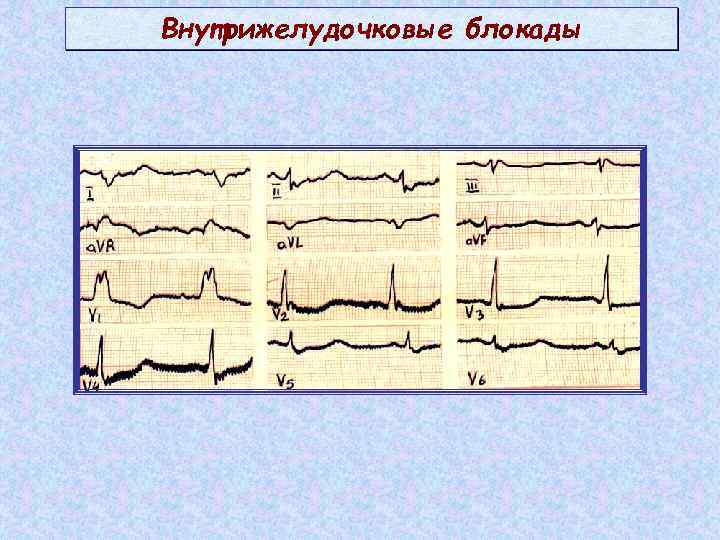 Внутрижелудочковые нарушения экг. Локальная внутрижелудочковая блокада на ЭКГ. Признаки внутрижелудочковой блокады на ЭКГ. Нарушение внутрижелудочковой проводимости блокада. Внутрижелудочковая блокада на ЭКГ У взрослого.