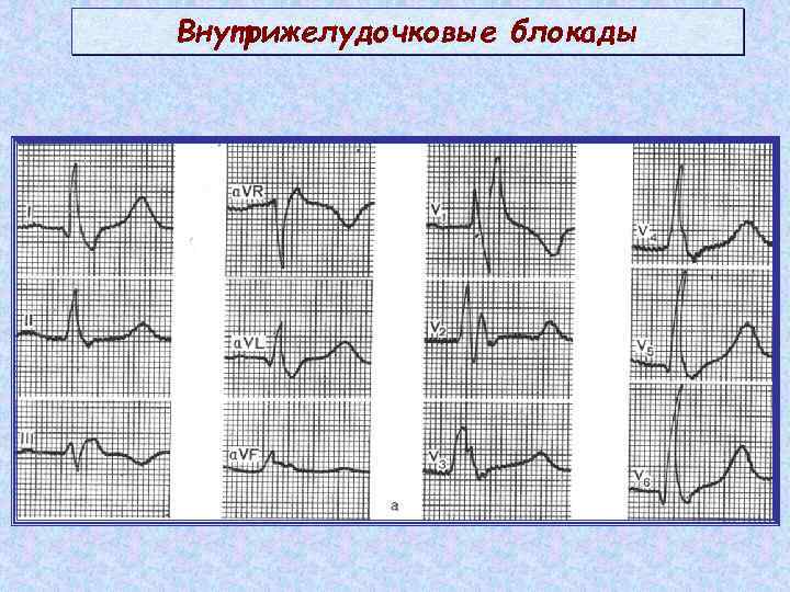 Нарушение внутрижелудочковой проводимости. Нарушения желудочковой проводимости на ЭКГ. Локальная внутрижелудочковая блокада на ЭКГ. Нарушение внутрижелудочковой проводимости на ЭКГ. ЭКГ при нарушении желудочковой проводимости.