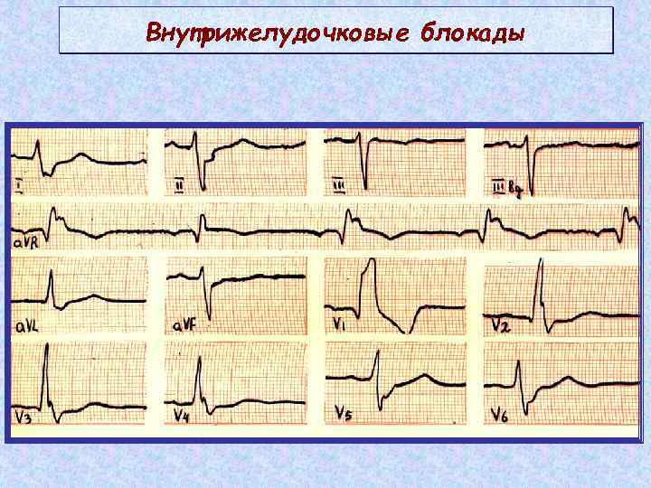 Нарушение проводимости на экг у взрослых. Внутрижелудочковые блокады на ЭКГ. Внутрижелудочковые блоакадына ЭКГ. Внутрижелудочковая блокада. Блокада левой ножки пучка Гиса.. Желудочковая блокада на ЭКГ.