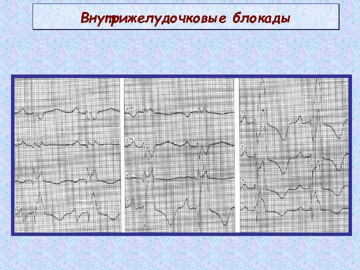 Очаговое нарушение внутрижелудочковой. Внутрижелудочковые блокады на ЭКГ. Локальная внутрижелудочковая блокада на ЭКГ. Внутрижелудочковая блокада QRS 122мс. Неспецифическая внутрижелудочковая блокада на ЭКГ.