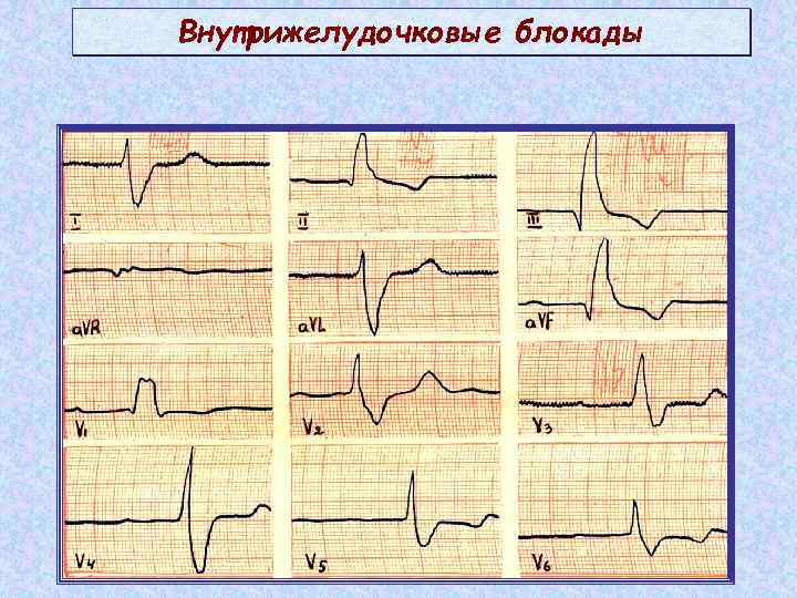 Нарушение внутрижелудочковой проводимости в области нижней стенки