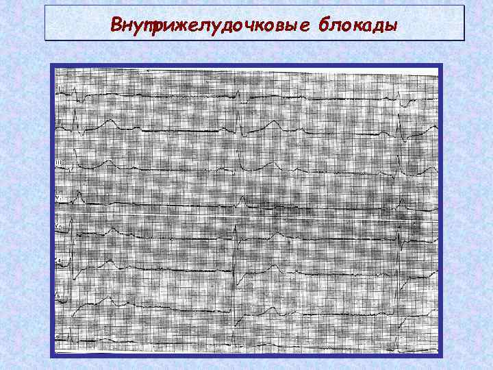 Местная внутрижелудочковая блокада в области нижней стенки