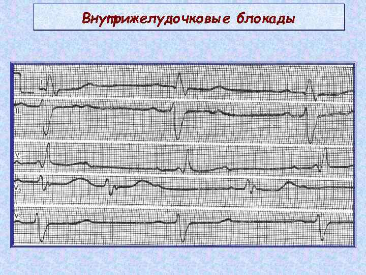 Внутрижелудочковые нарушения экг. Признаки внутрижелудочковой блокады на ЭКГ. Внутрижелудочковые блокады на ЭКГ. Локальная внутрижелудочковая блокада на ЭКГ. Очаговая блокада на ЭКГ.