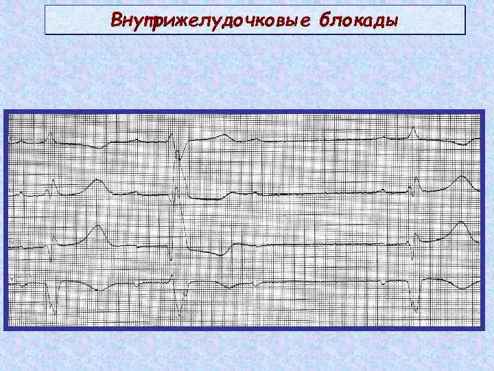 Внутрижелудочковые блокады 