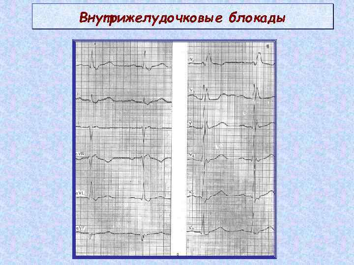 Внутрижелудочковые блокады 