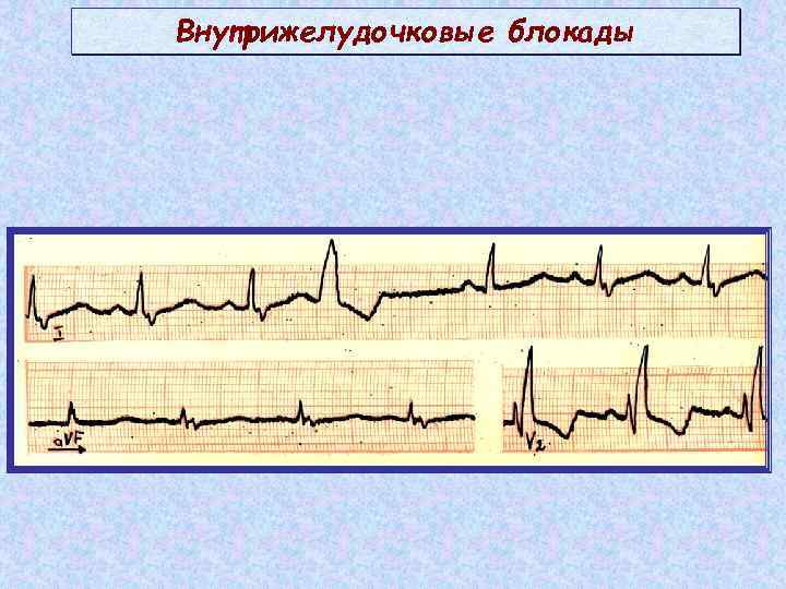 Местные нарушения внутрижелудочковой проводимости на экг