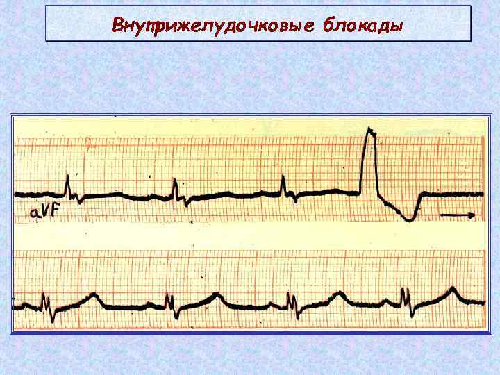 Внутрижелудочковые блокады 