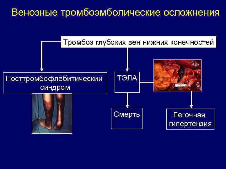 Венозные тромбоэмболические осложнения Тромбоз глубоких вен нижних конечностей Посттромбофлебитический синдром ТЭЛА Смерть Легочная гипертензия