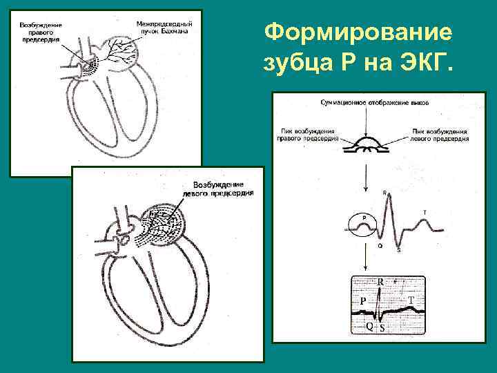 Формирование зубца Р на ЭКГ. 