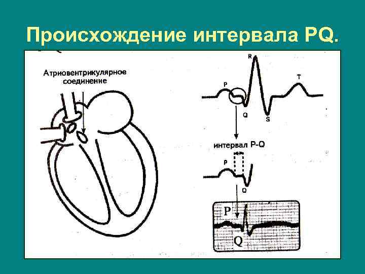 Происхождение интервала PQ. 