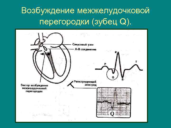 Возбуждение межжелудочковой перегородки (зубец Q). 
