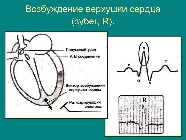 Возбуждение верхушки сердца (зубец R). 