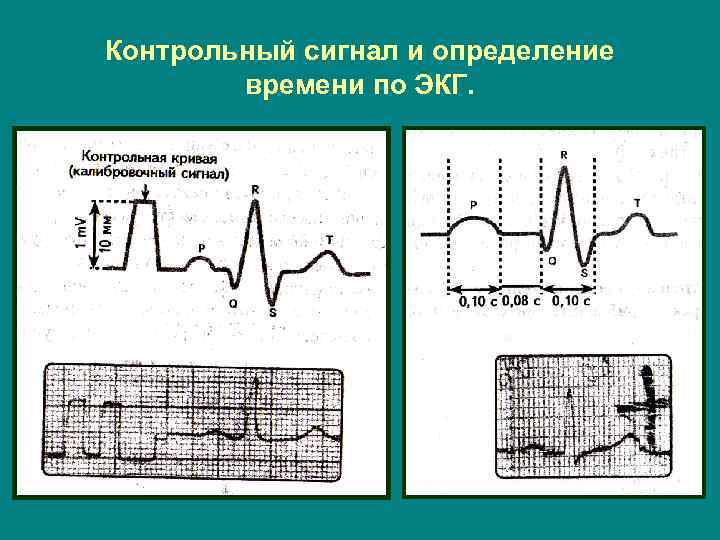 Контрольный сигнал и определение времени по ЭКГ. 