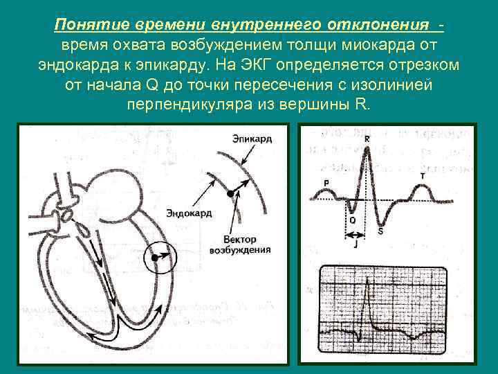 Понятие времени внутреннего отклонения время охвата возбуждением толщи миокарда от эндокарда к эпикарду. На