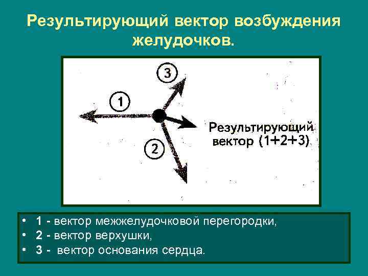 Результирующий вектор возбуждения желудочков. • 1 - вектор межжелудочковой перегородки, • 2 - вектор
