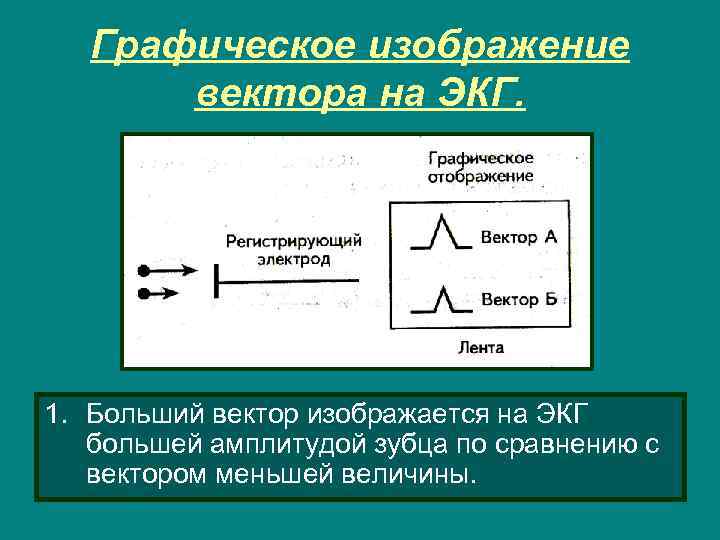 Графическое изображение вектора на ЭКГ. 1. Больший вектор изображается на ЭКГ большей амплитудой зубца