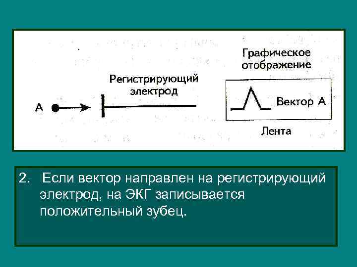 2. Если вектор направлен на регистрирующий электрод, на ЭКГ записывается положительный зубец. 