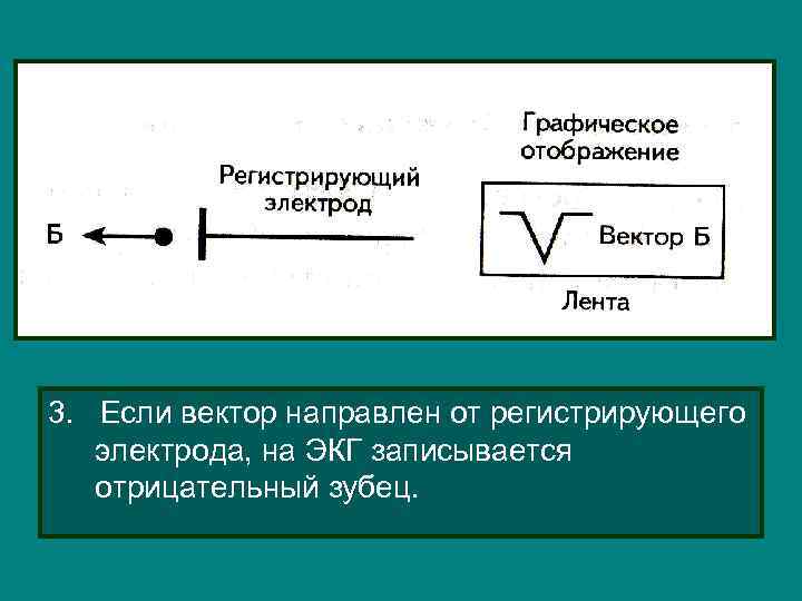 3. Если вектор направлен от регистрирующего электрода, на ЭКГ записывается отрицательный зубец. 