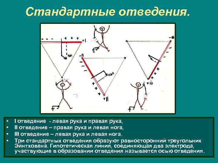 Стандартные отведения. • • I отведение - левая рука и правая рука, II отведение