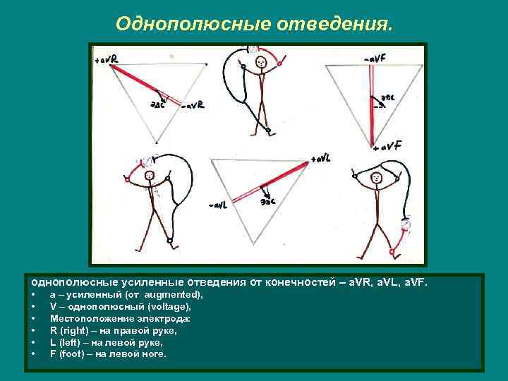 Однополюсные отведения. однополюсные усиленные отведения от конечностей – a. VR, a. VL, a. VF.