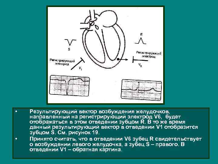  • • Результирующий вектор возбуждения желудочков, направленный на регистрирующий электрод V 6, будет