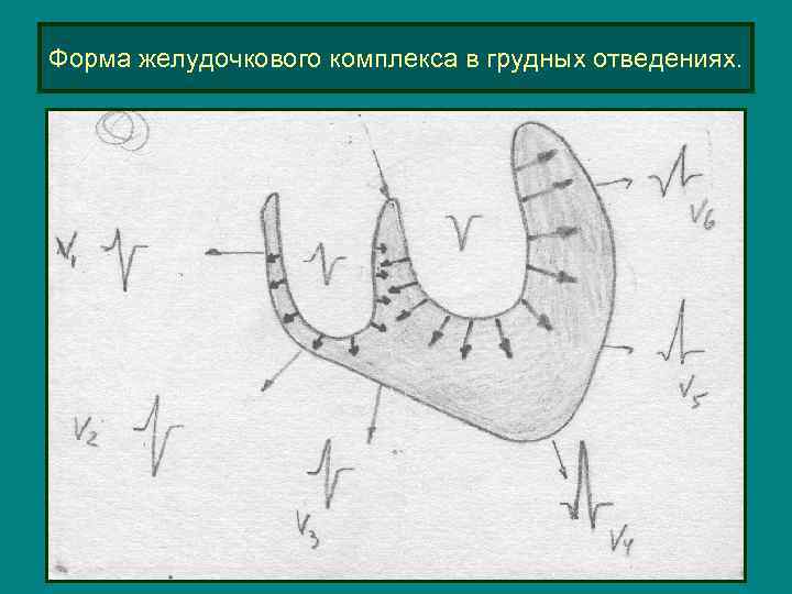 Форма желудочкового комплекса в грудных отведениях. 