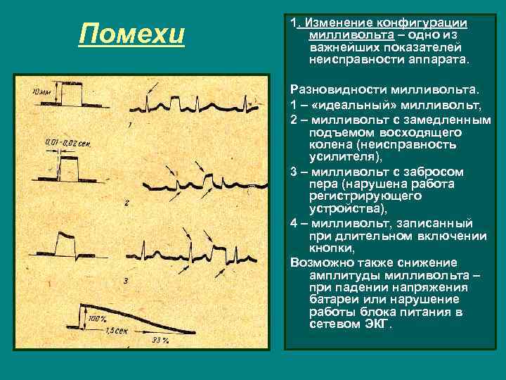 Помехи 1. Изменение конфигурации милливольта – одно из важнейших показателей неисправности аппарата. Разновидности милливольта.