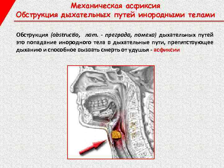 Механическая асфиксия Обструкция дыхательных путей инородными телами Обструкция (obstructio, лат. - преграда, помеха) дыхательных