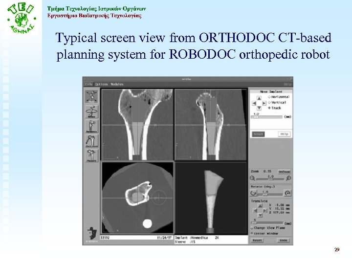 Typical screen view from ORTHODOC CT-based planning system for ROBODOC orthopedic robot 29 